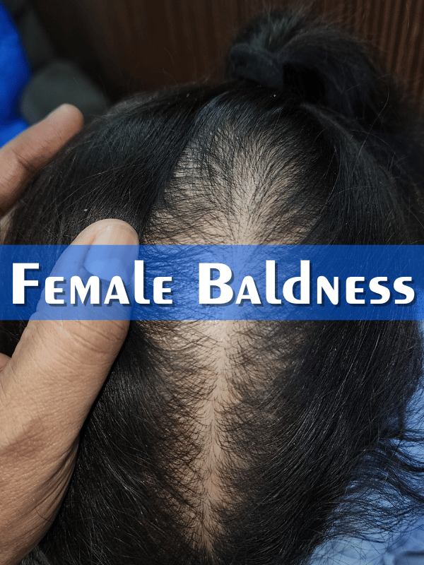 Female Baldness Treatment